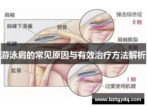 游泳肩的常见原因与有效治疗方法解析